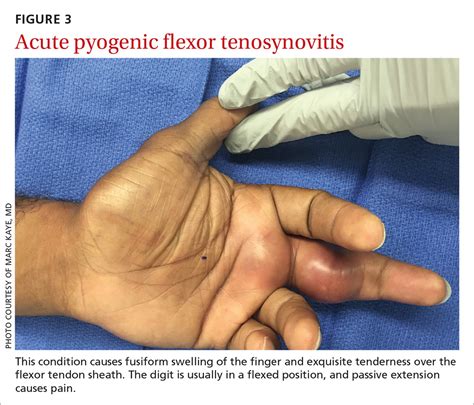 flexor tenosynovitis of finger icd 10